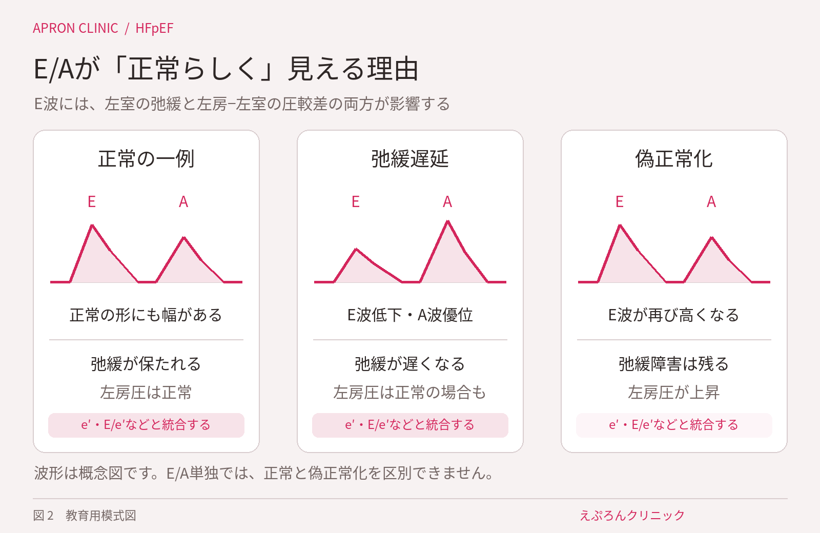 正常、弛緩遅延、偽正常化の僧帽弁流入波形の模式図。偽正常化ではE波が再上昇してもe′低下が残り得る