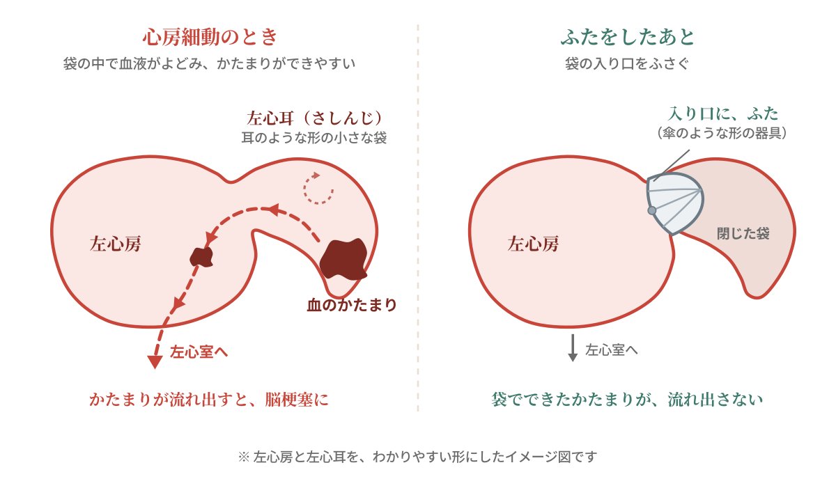 心房細動のときと、ふたをしたあとの左心房と左心耳を比べた図。心房細動のときは左心耳という小さな袋の中で血液がよどんで血のかたまりができ、左心房を通って左心室へ流れ出すと脳梗塞の原因になる。ふたをしたあとは袋の入り口がふさがれ、かたまりが流れ出さない