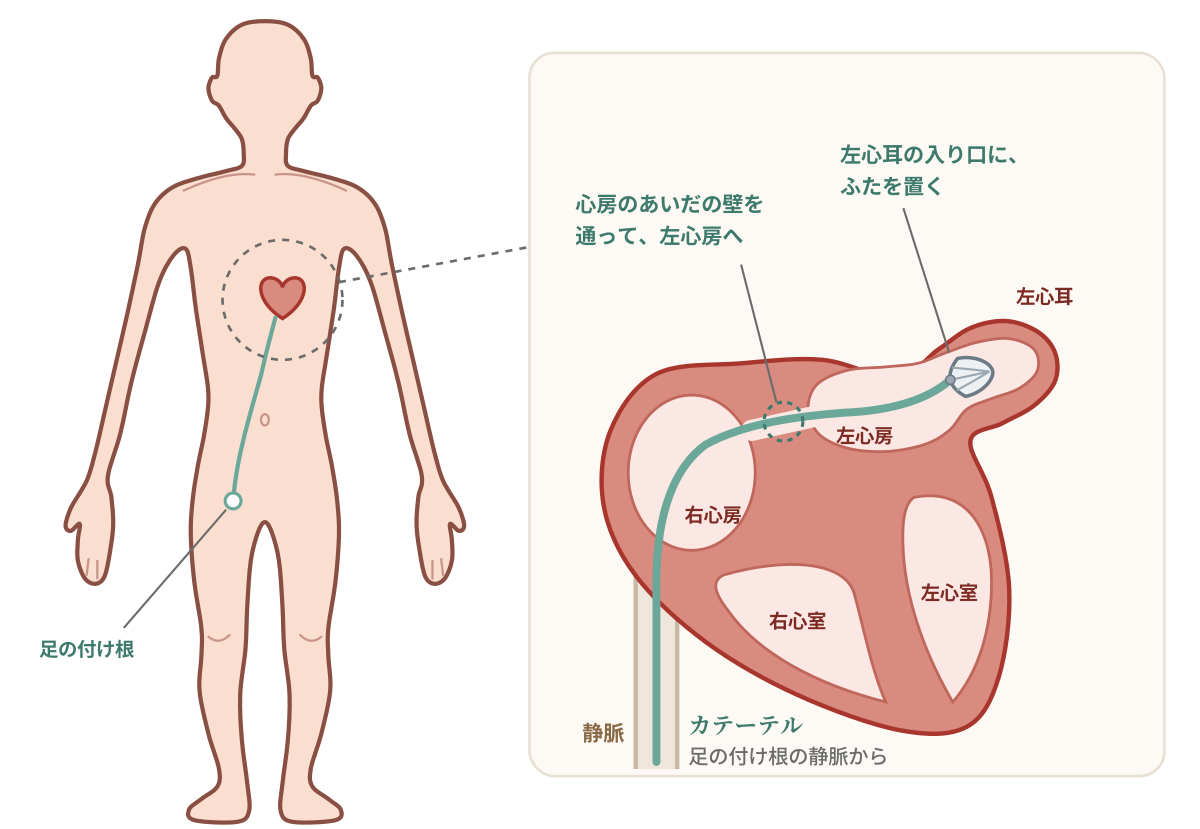 カテーテルの通り道を示した図。足の付け根の静脈からカテーテルを進め、右心房から心房のあいだの壁を通って左心房に入り、左心耳の入り口にふたを置く