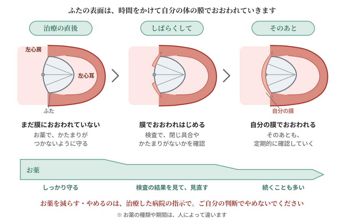 治療のあとの時間の流れを示した図。ふたの表面は時間をかけて自分の体の膜でおおわれていく。そのあいだはお薬で守り、検査の結果を見ながらお薬を見直す。お薬を減らす・やめるのは治療した病院の指示で行う