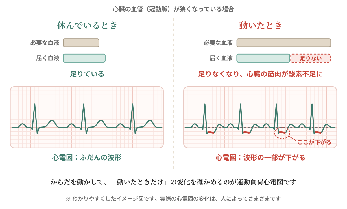 冠動脈が狭くなっている場合に、休んでいるときと動いたときを比べた図。休んでいるときは心臓の筋肉に届く血液が足りていて、心電図はふだんの波形。動いたときは、必要な血液に届く量が追いつかずに酸素不足になり、心電図の波形の一部が下がる。わかりやすくしたイメージ図